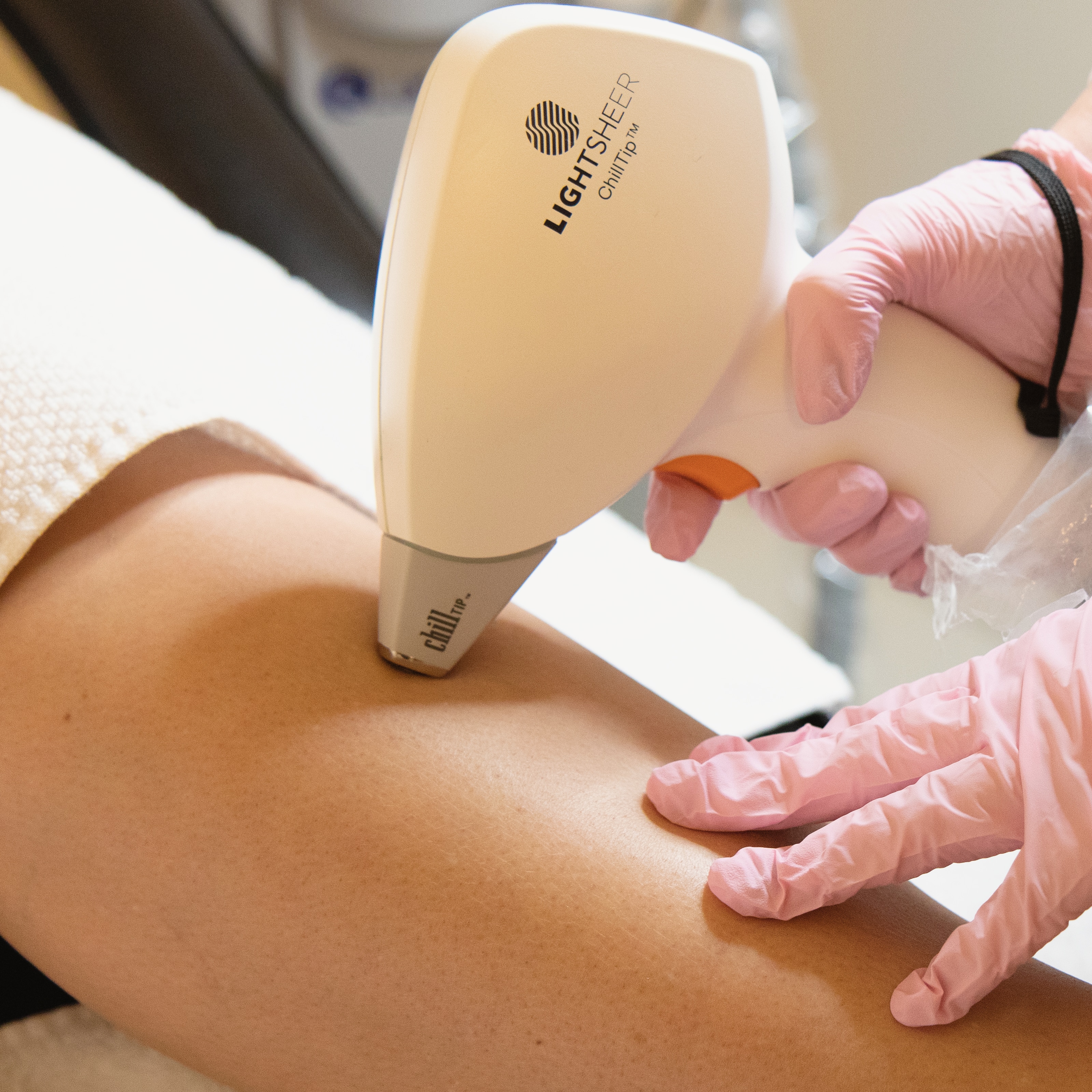 Foto van laserontharing been